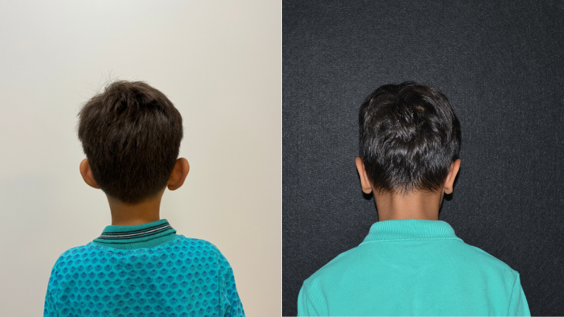 Conheça com o Dr. Milton Seigi Hayashi cada etapa da cirurgia infantil que transforma autoestima e confiança.